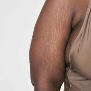 How To Get Rid Of Stretch Marks On Arms